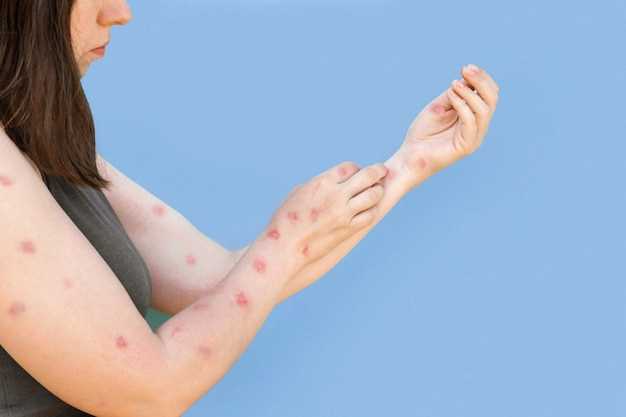 Что вызывает аллергический дерматит?
