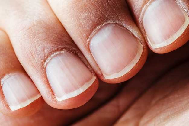 Как избежать появления вмятин на ногтях