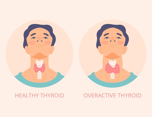 Какие симптомы возникают при проблеме с щитовидной железой?